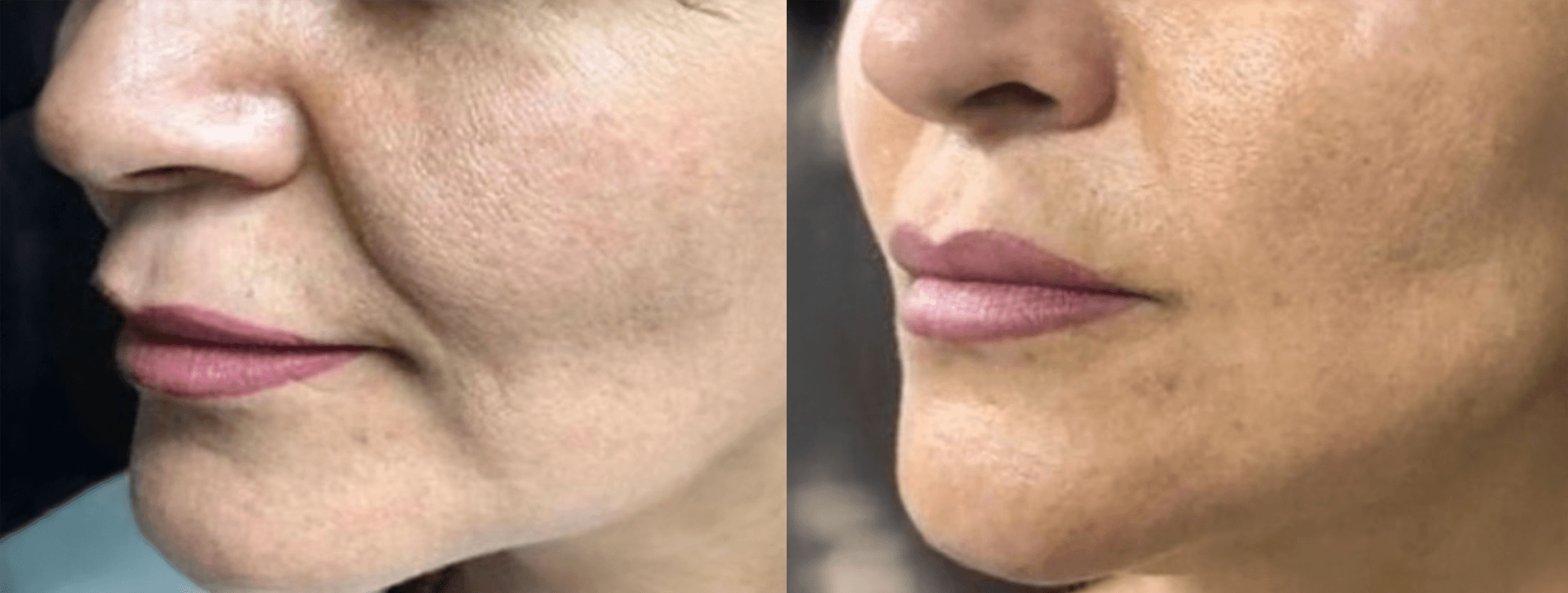 Example of Exosomes effect