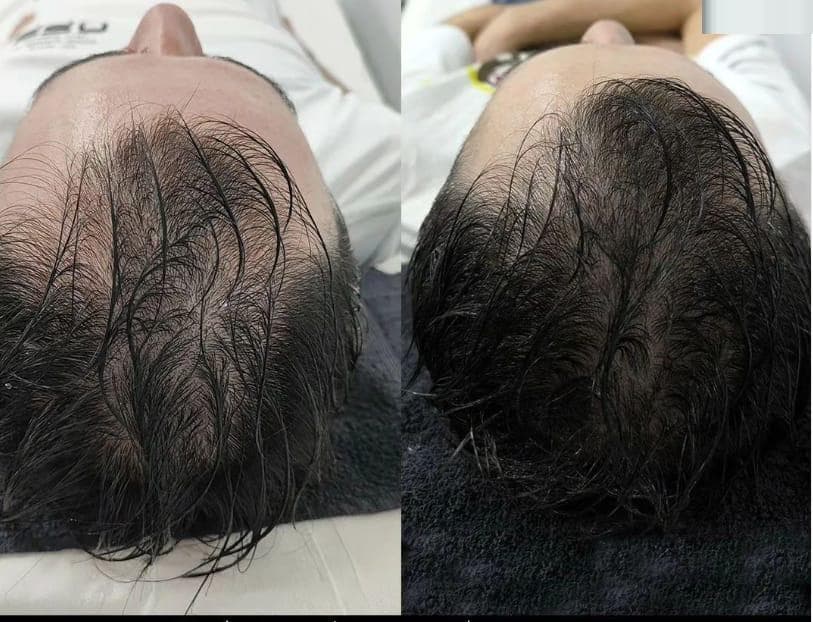 Example of Exosomes effect