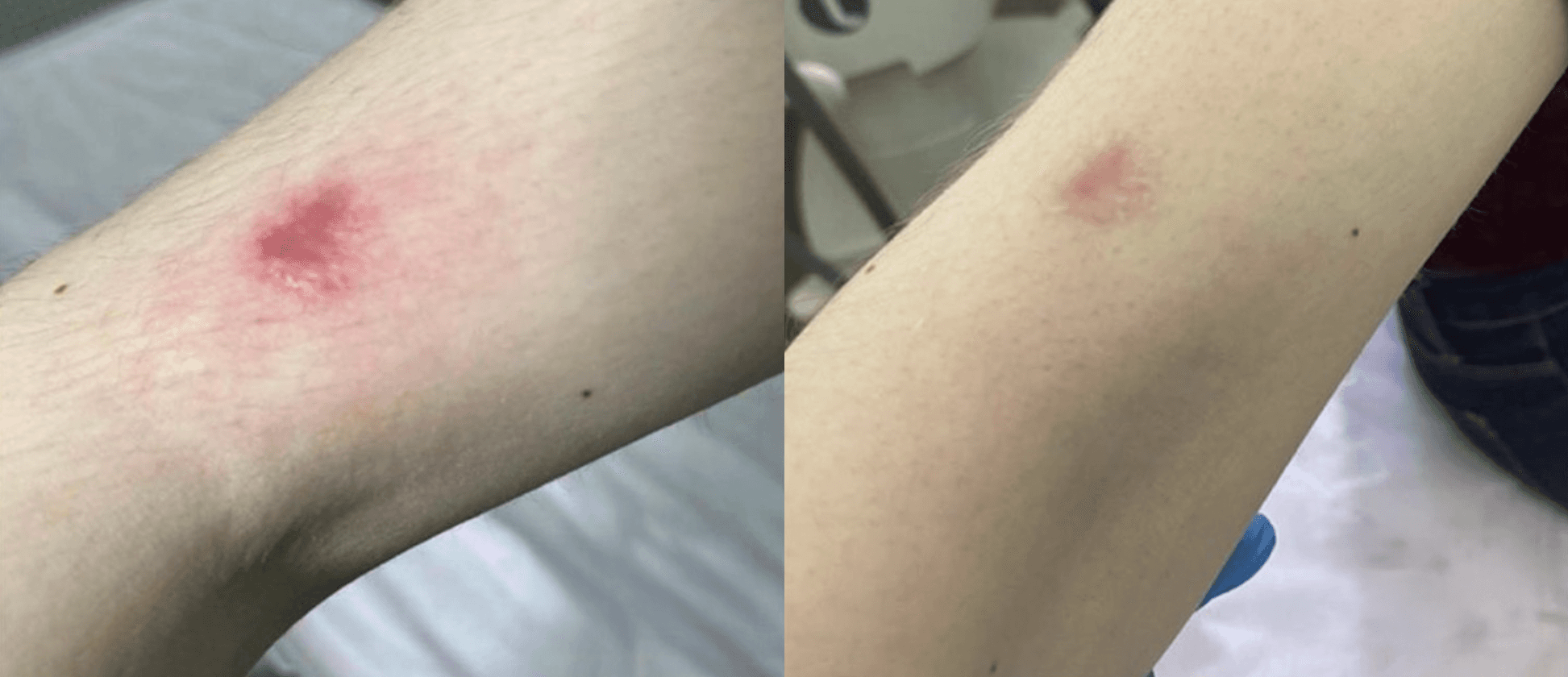 Example of Exosomes effect